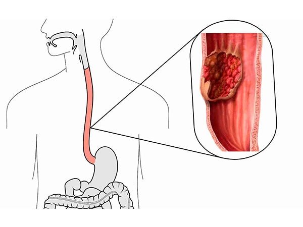 Local onde ocorre o Câncer de esôfago
