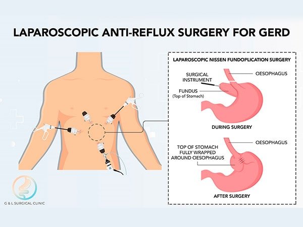 Cirurgia de refluxo