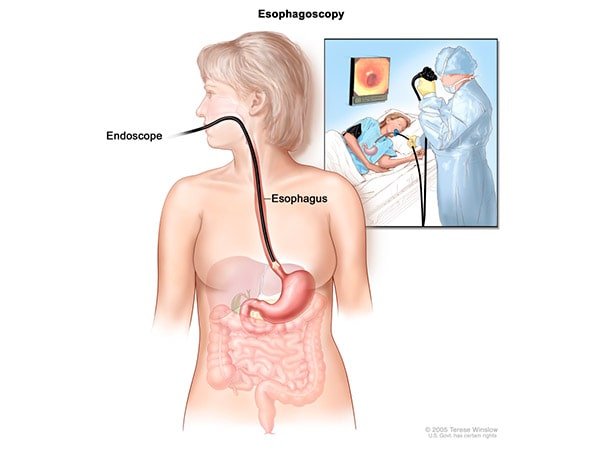 Exame para detectar Câncer de esôfago 