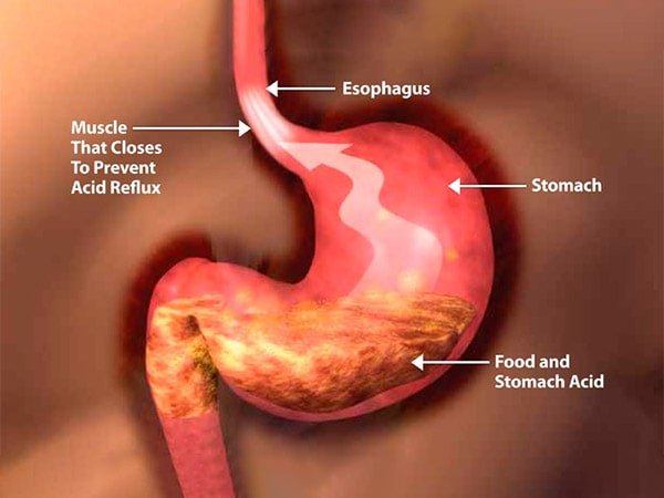 órgão onde é realizada a Cirurgia de refluxo