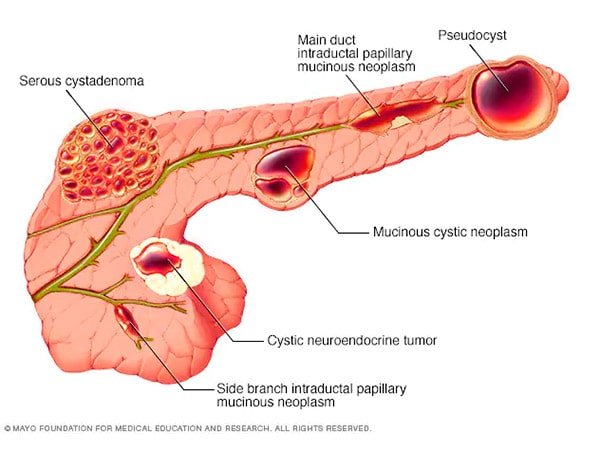 Inflamação no pâncreas