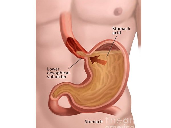 Cirurgia de refluxo