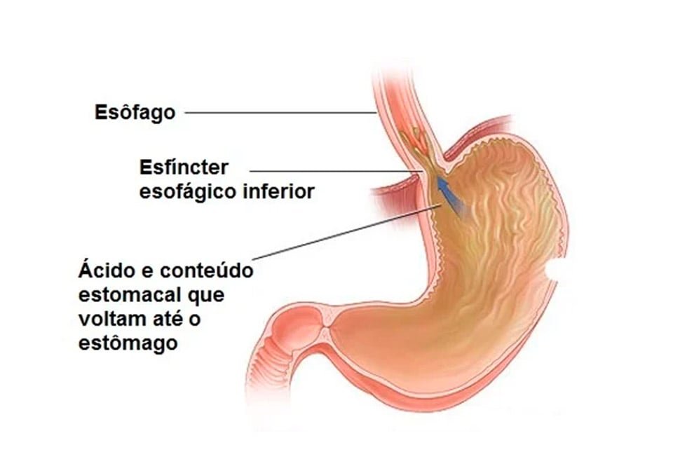 doença do refluxo gastroesofágico