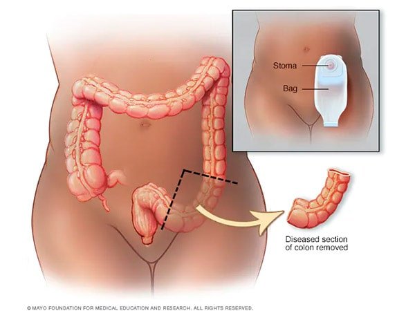 Ressecção do Intestino