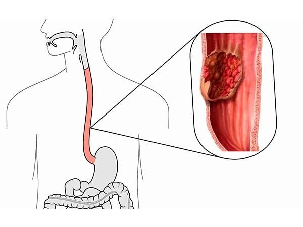 Local onde ocorre o Câncer de esôfago