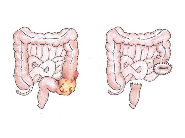 Ressecção do Intestino